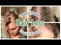 MY HAIR LOSS EXPERIENCE | TELOGEN EFFLUVIUM