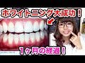 【美容】ステイン歯から白い歯に…歯医者のホワイトニング1ヶ月間の経過報告！！【大成功】