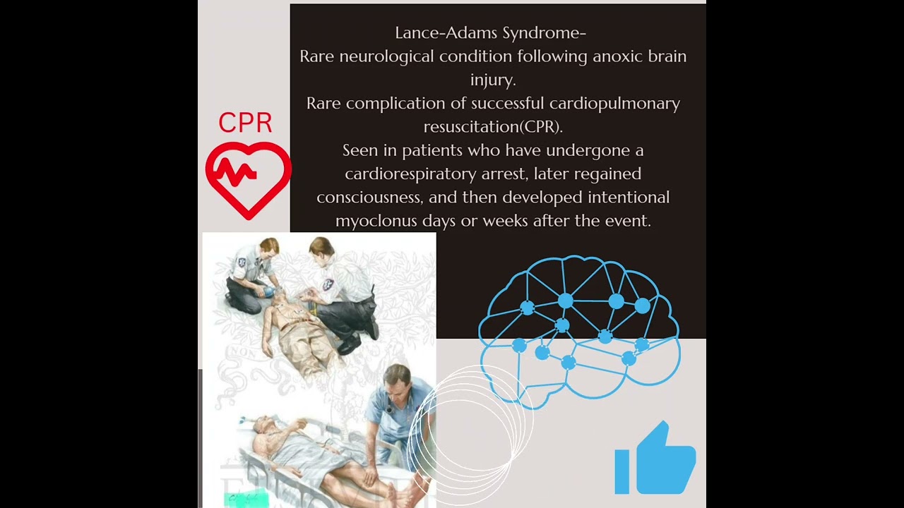 Lance Adams syndrome neurology neuro disorder YouTube