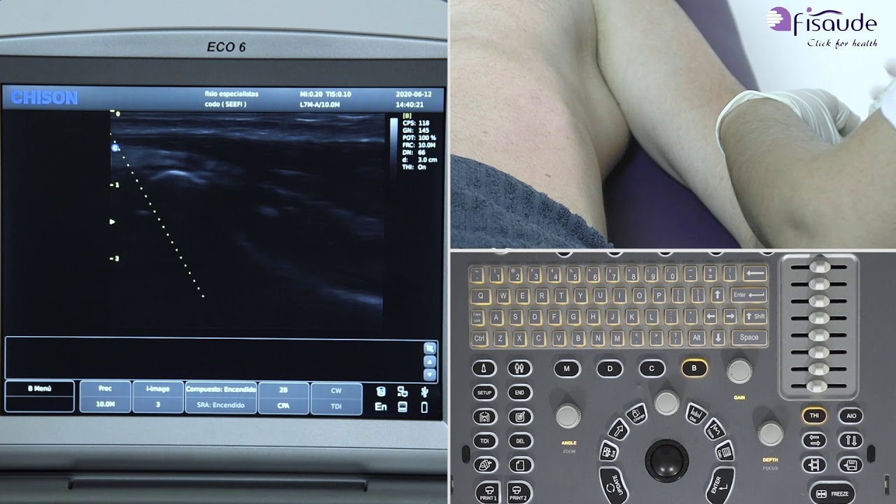 Ecografía del codo y punción ecoguiada con el ecógrafo Chison Eco 6