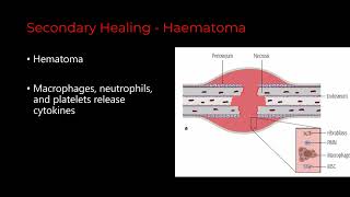 How does fracture heal? Stages of Bone Healing. Dr Kathir Stalin