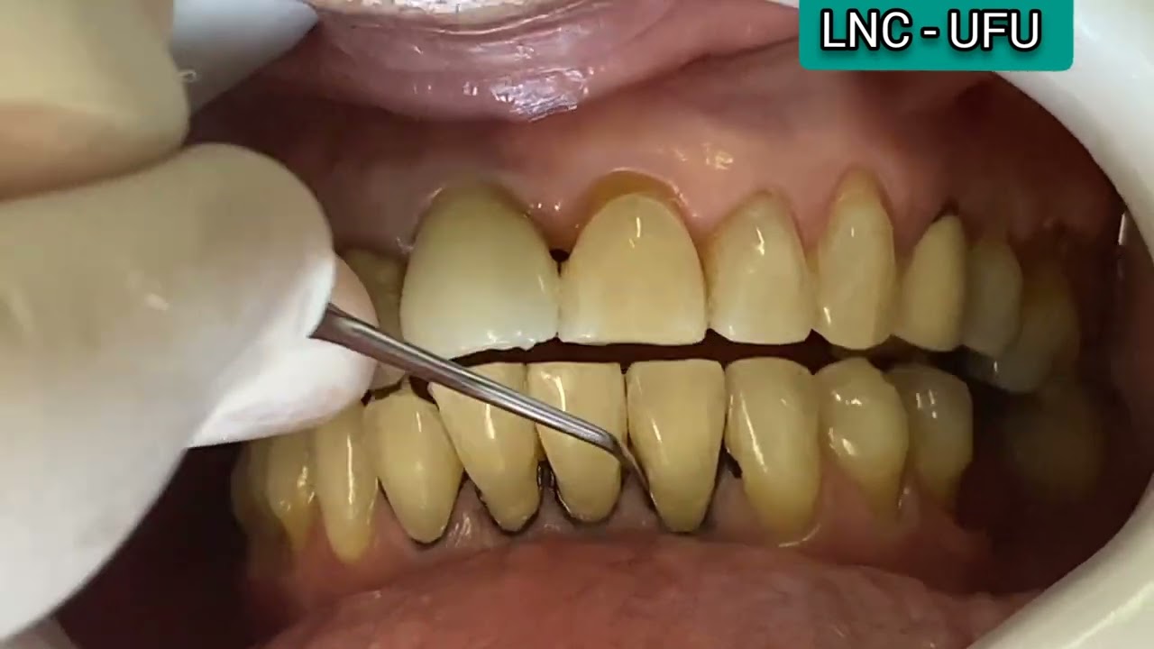 Hipersensibilidade Dentinária: protocolo de dessensibilização