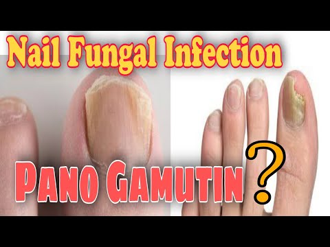 Video: Paano Gamutin Ang Fungus Ng Kuko Sa Mga Bata