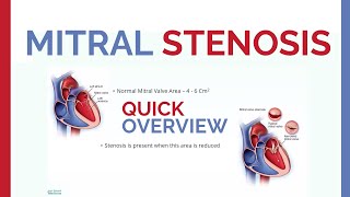 Mitral Stenosis - Overview & Revise