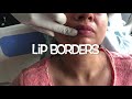 How To Get Filler,Attractive And Sensous Lips ??  Procedure Of Dermal Fillers