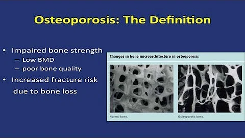 Save Your Bones: Osteoporosis Update 2014 - Research on Aging - DayDayNews