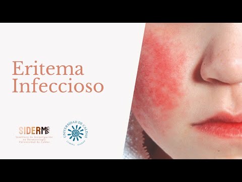 Vídeo: Eritema Infeccioso: Síntomas, Diagnóstico, Tratamiento