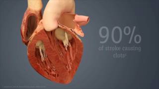 Device Reduces Stroke Risk, Eliminates Need for Blood Thinners in Patients with Atrial Fibrillation