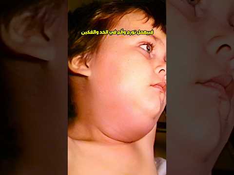 مرض النكاف التهاب الغده النكافيه في صحة اطفالنا  فيروس تطعيم عدوى