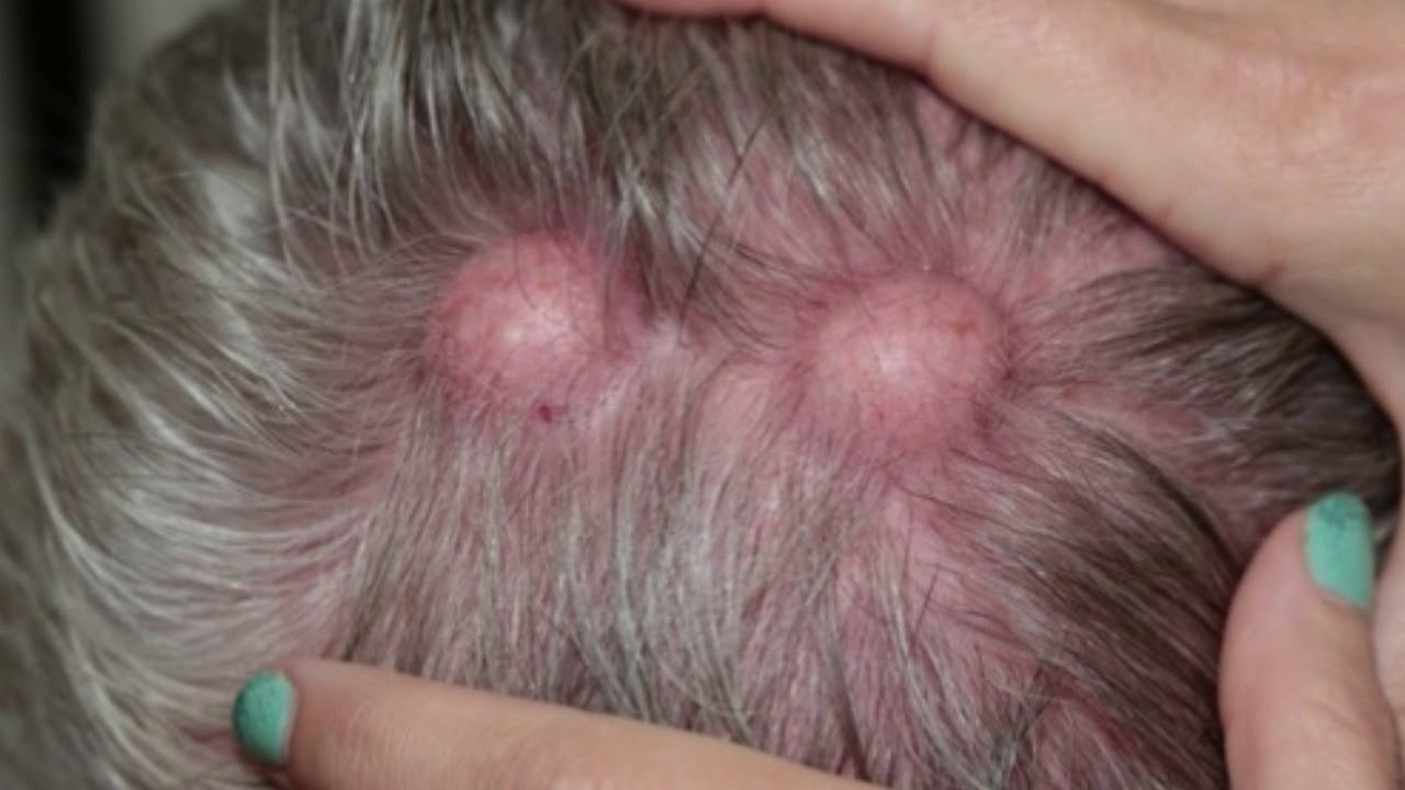 Scalp Pimple Pop