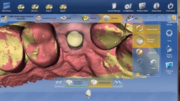 inLAB 4.0  Using Glidewell Tibase for screw retained implant crown