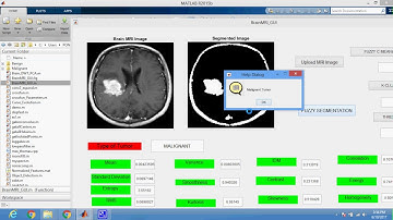 MRI Image Segmentation Using Fuzzy C Means Clustering, K Clustering and Thresholding