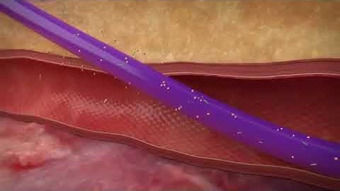 ARROW PICC with Chloragard Technologyyoutube com