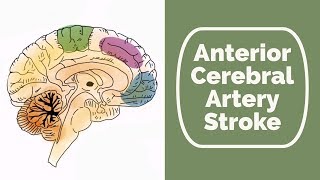 Anterior Cerebral Artery Stroke