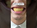 yellow teeth!?