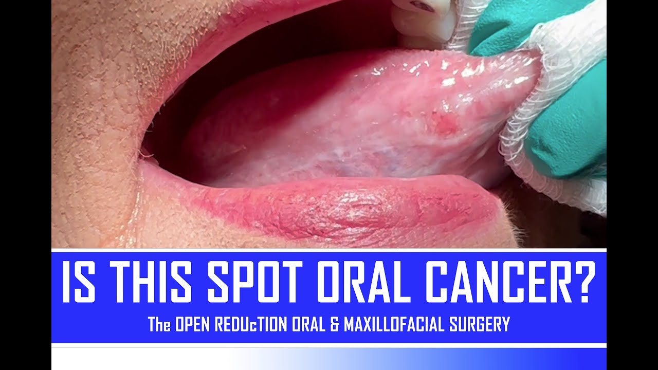 is-this-spot-oral-cancer-how-to-identify-oral-cancer-youtube