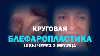 Круговая блефаропластика через 2 месяца: шрамы после пластики век