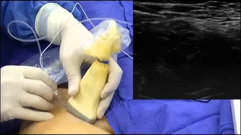 Ultrasound-Guided Femoral Nerve Block