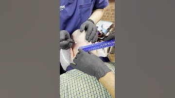 Why do you need “Multiple Sessions “ of Scalp-Micropigmentation?