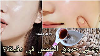 علاج حروق شمس بعد البحر /التخلص  من تصبغات البشرة في أسرع وقت (تفتيح و تبييض البشره )