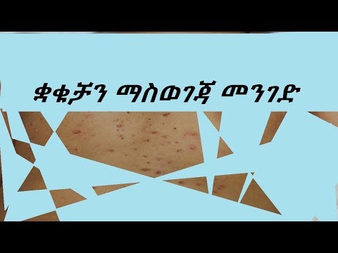 ቪዲዮ: Eczema ን በተፈጥሮ መንገድ ለማከም 13 መንገዶች