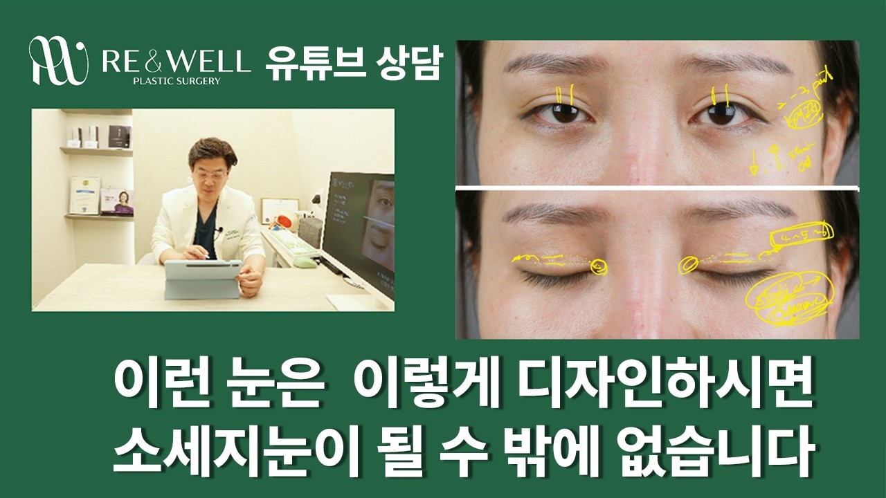 소세지 쌍커풀로 눈재수술을 고민하시는 분의 사연입니다. 유튜브 상담 컨텐츠