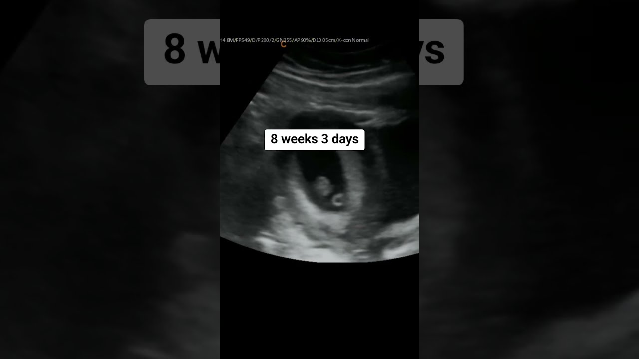 Baby Yolk Sac At 8 Weeks 3 Days Pregnant Heybabymobile Yolksac 8weeks3dayspregnant Ultrasound