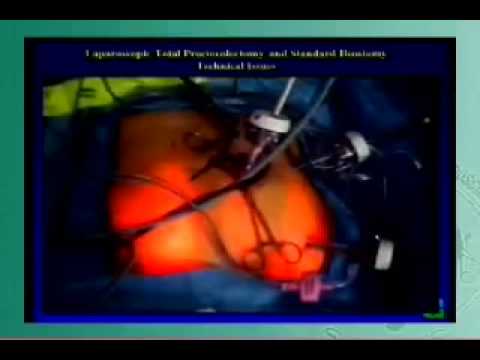 Laparoscopic Total Proctocolectomy And Standard Ileostomy