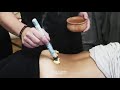 Moxibustion techniques