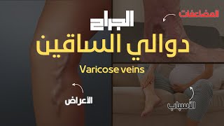 دوالي الساقين ( varicose veins) | هتعرف كل حاجة 