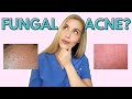 Do YOU have Fungal Acne? | Dermatologist Talks Symptoms and Treatments!