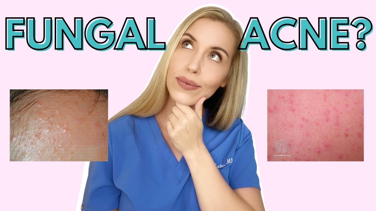 Do YOU have Fungal Acne? | Dermatologist Talks Symptoms and Treatments
