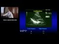 Echocardiography & Doppler Basics...Physics...Etc (William A. Zoghbi, MD) Sep. 15, 2015