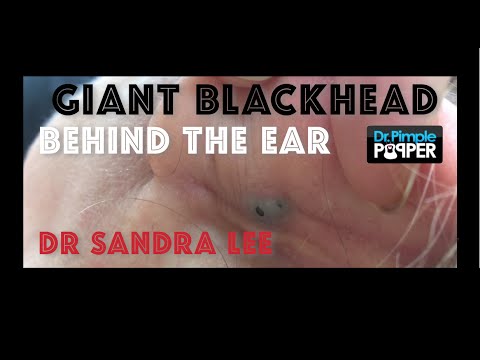 Giant Blackhead, Dilated Pore of Winer, behind the ear extracted