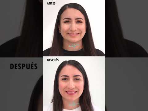 Aplicación toxina botulínica (BOTOX)