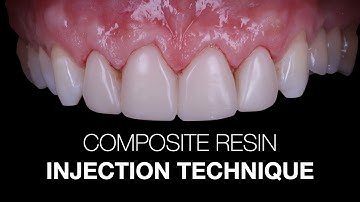 Composite Resin Injection Technique: setp by step