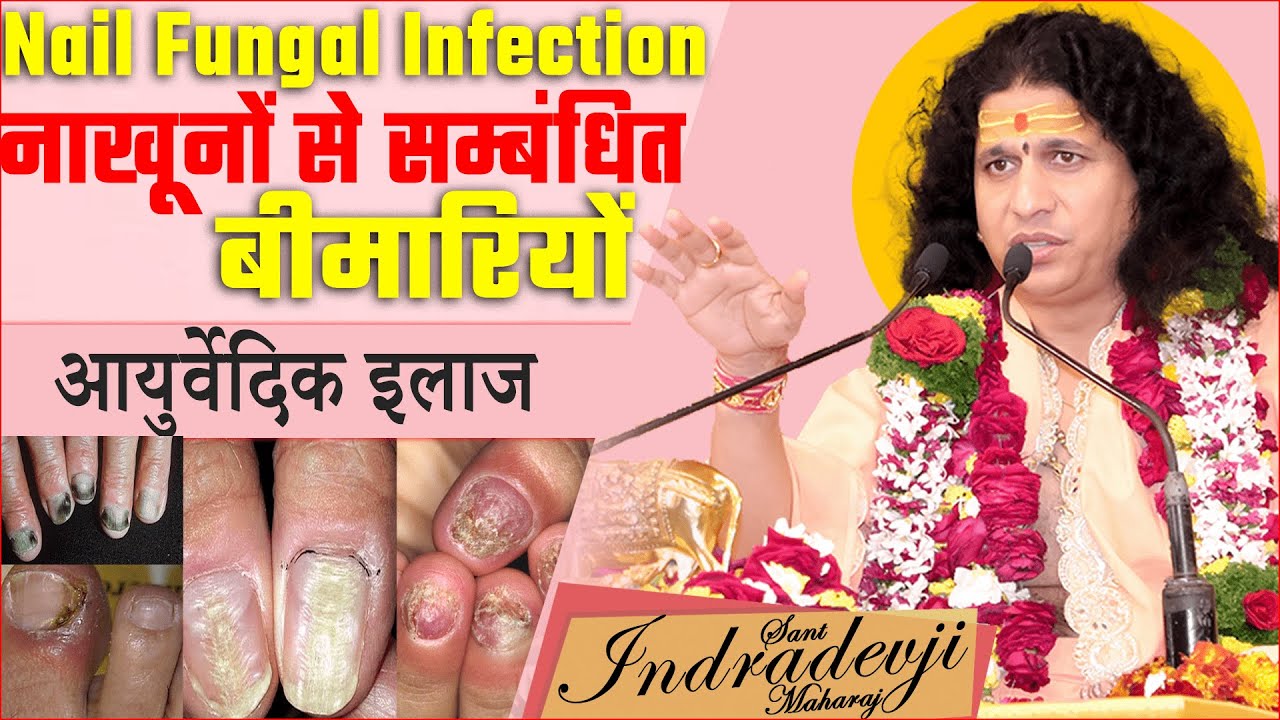 Effective Treatments for Nail Fungus