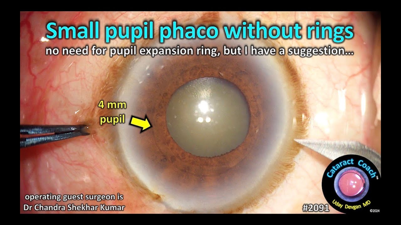 SciELO - Brasil - Efficacy of the Canabrava Ring (pupil expansion device)  in cataract surgery for eyes with small pupils: the first 30 cases Efficacy  of the Canabrava Ring (pupil expansion device)