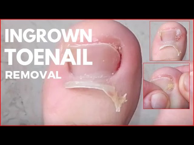Video People Removing Their Ingrown Toenails Business Insider