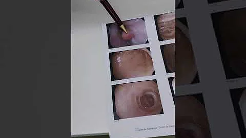 Como tratar lesão no estômago?