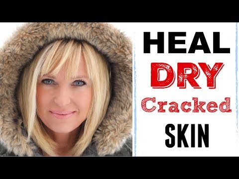 HOW TO: Heal DRY Cracked Skin FAST! FACE & BODY!