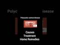 Pcod Causes and Treatment#shorts #trending #health #pcod