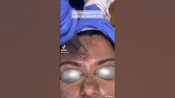 Hollywood Laser Peel Treatment #shorts