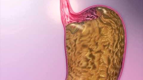 GERD: Learn@Visible Body