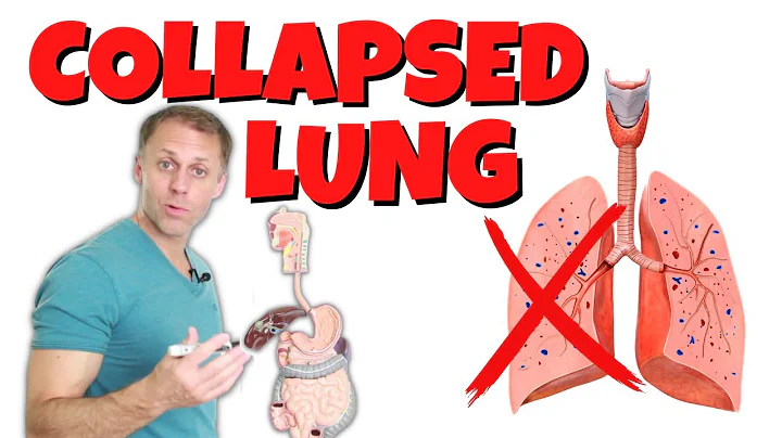 My Spontaneous Pneumothorax (Collapsed Lung) Insights