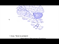 Extrapyramidal neuron lesion---Rigidity(Spasticity VS Rigidity)
