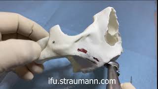 Dr.  Bedrossian Zygomatic Hands on Demo