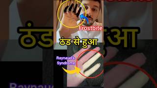Frost Bite vs Raynauds phenomenon
