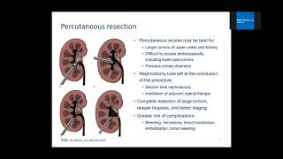 “Kidney-Sparing Surgery for Upper Tract Urothelial Carcinoma” Wealth