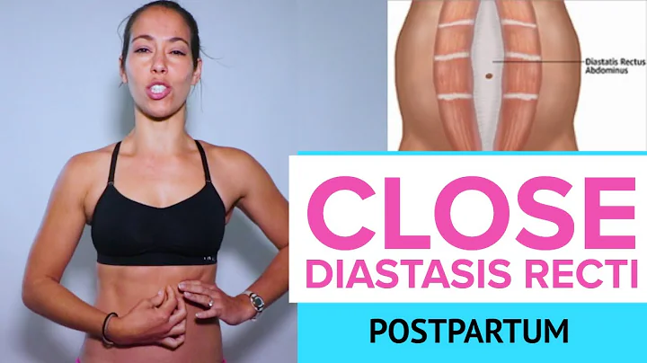 Heal Diastasis Recti with one Exercise | Close the...